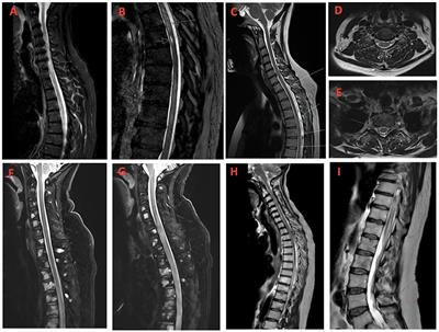 Case series: Immune checkpoint inhibitor-induced transverse myelitis